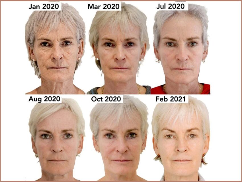Durham aesthetician reveals the non-surgical treatment behind Judy Murray’s transformation