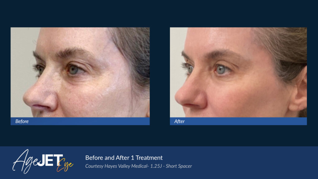 RT Aesthetics Whickham AgeJet Plasma