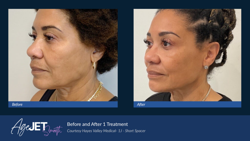 RT Aesthetics Whickham AgeJet Plasma