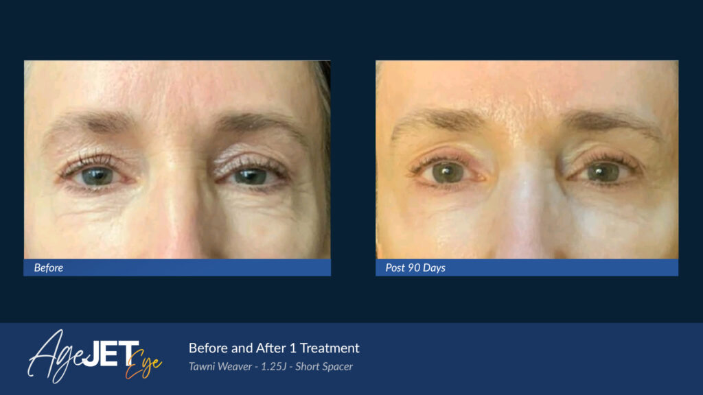 RT Aesthetics Whickham AgeJet Plasma