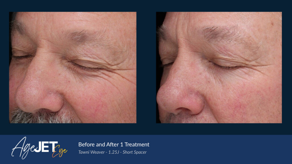RT Aesthetics Whickham AgeJet Plasma