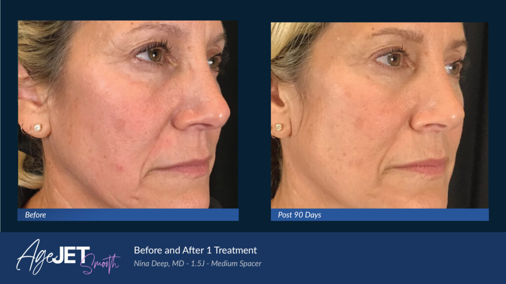 RT Aesthetics Whickham AgeJet Plasma
