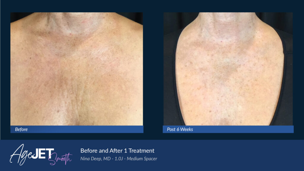 RT Aesthetics Whickham AgeJet Plasma