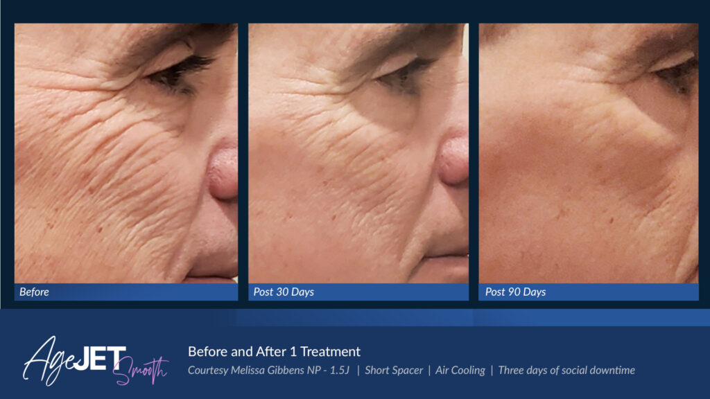 RT Aesthetics Whickham AgeJet Plasma