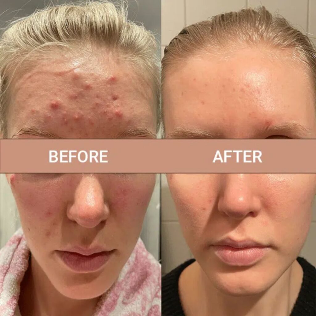 RT Aesthetics chemical skin peel